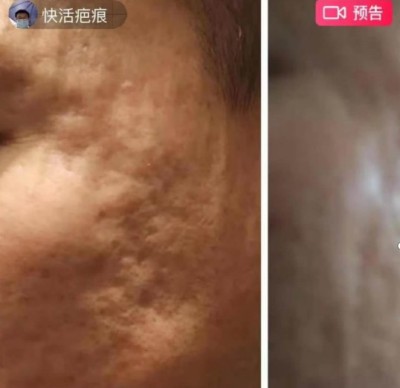 回归本源，让疤痕收回本该易防易治的本来形象！  去除疤痕——几千年做错了这一件事  排毒养疤——让疤痕还回了本容易康复的事情