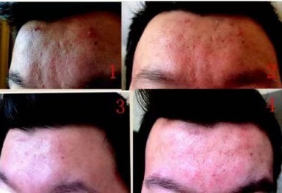 回归本源，让疤痕收回本该易防易治的本来形象！  去除疤痕——几千年做错了这一件事  排毒养疤——让疤痕还回了本容易康复的事情