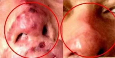 回归本源，让疤痕收回本该易防易治的本来形象！  去除疤痕——几千年做错了这一件事  排毒养疤——让疤痕还回了本容易康复的事情