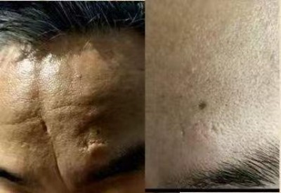 回归本源，让疤痕收回本该易防易治的本来形象！  去除疤痕——几千年做错了这一件事  排毒养疤——让疤痕还回了本容易康复的事情