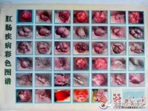 【5月10日】肛肠病穴位针挑疗法班~大胡子痔疮王雷虎成