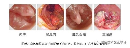 【5月10日】肛肠病穴位针挑疗法班~大胡子痔疮王雷虎成